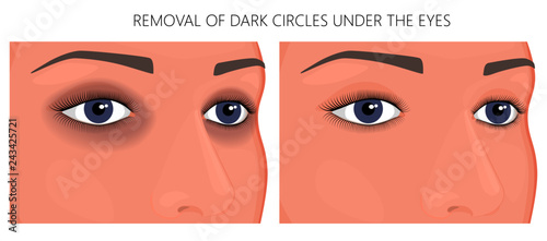 Vector illustration. Female eyes with dark circles around the eyes and without dark circles. For advertising funds for the treatment of this problem and medical publications about it.