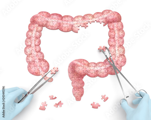 Large intestine puzzle concept: hands of surgeon with surgical tools perform colon surgery as a result of diverticulitis, Colitis ulcerosa, appendicitis, Crohn's disease, proctitis, colonic polyp