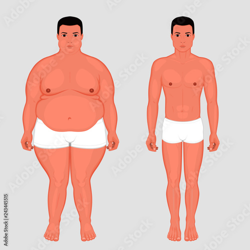 Vector illustration body weight loss in a European man from obesity to normal. Front view. For advertising of cosmetic plastic procedures, stomach shunting, diet; medical publications