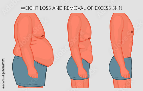 Vector illustration. Human body problem after Weight loss, excess skin  removal in man. Side view. For advertising of cosmetic plastic procedures, for medical publications