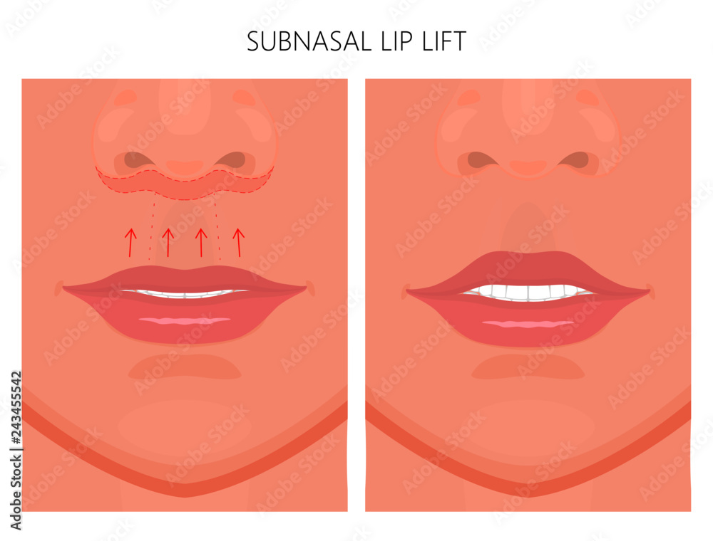 Vector illustration. Subnasal lip lift steps on women face, after procedure. Close up view. For advertising of medicinal, cosmetic and plastic surgery and procedures Vector illustration. Subnasal lip lift steps on women face, after procedure. Close up view. For advertising of medicinal, cosmetic and plastic surgery and procedures