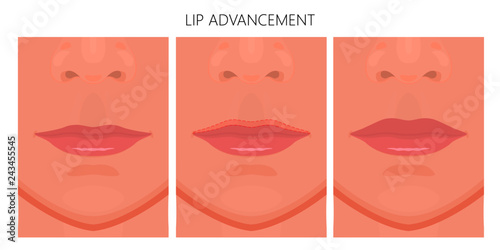Vector illustration. Upper lip Advancement on woman face before and after surgery. Close up view. For advertising of medicinal, cosmetic, plastic surgery, beauty procedures