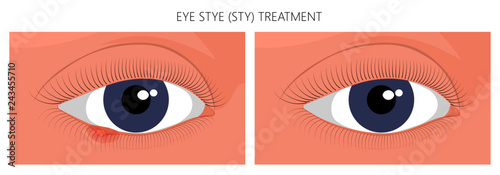 Vector illustration. Eye Stye (Sty) problem before and after treatment. Close up view. For advertising, medicinal publications