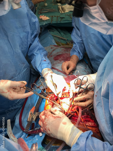 Close up of surgeon team performing real medical sternotomy, open chest, organ transplantation surgery on patient. Healthcare and medicine. photo