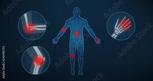 Joint inflammation and medical treatment photo