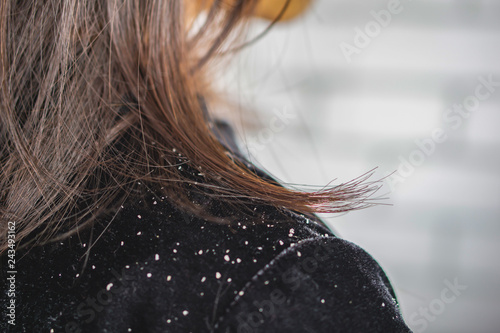  closeup woman hair with dandruff falling on shoulders photo
