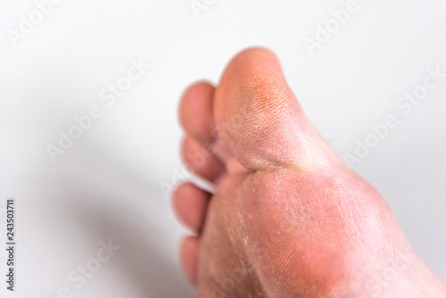 Dry woman big toe with rough skin on gray background.