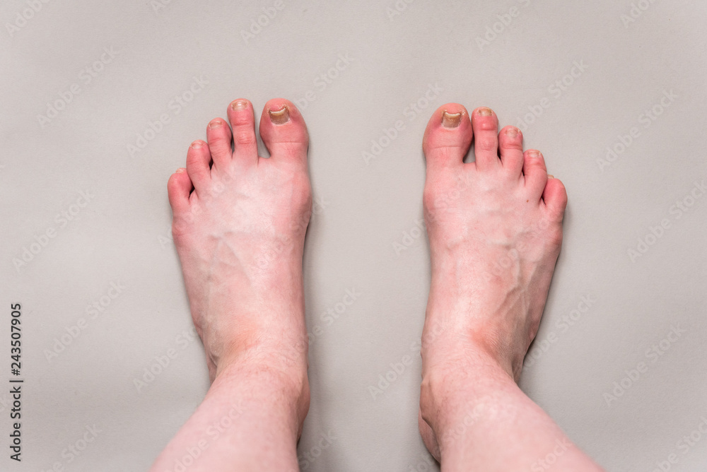 Fototapeta premium Damaged toenail on big toe on gray background. Callus on foot.