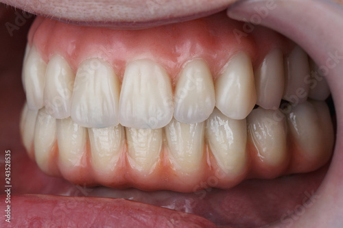 set high quality Dental prostheses, filmed with a professional lighting at an angle