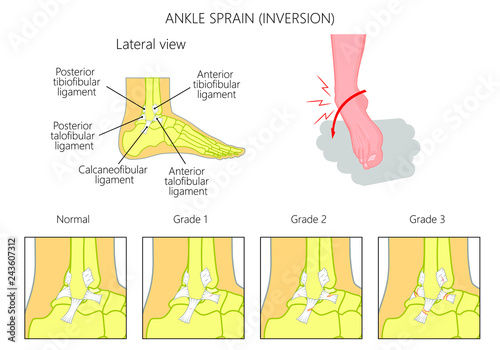 Mechanism of formation of an ankle sprain and Grades of an ankle sprain (Inversion) illustration with external and skeletal (lateral) view