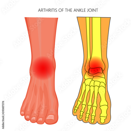 Vector illustration of Arthritis of an ankle joint. Front view of the human foot with pain.
