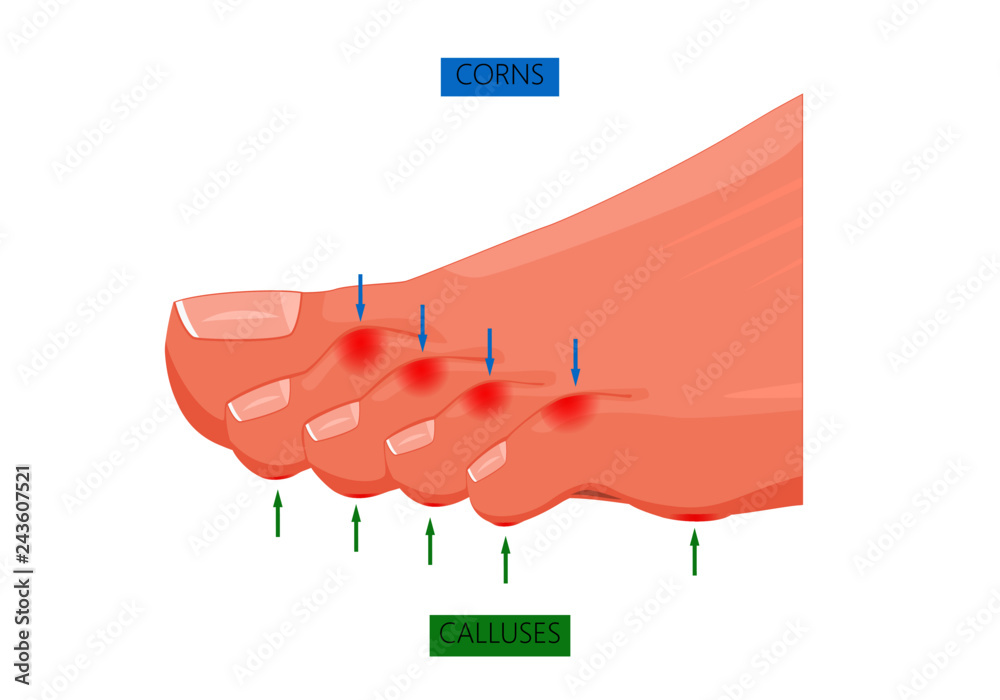 Illustration of difference between Corns and calluses Stock Vector