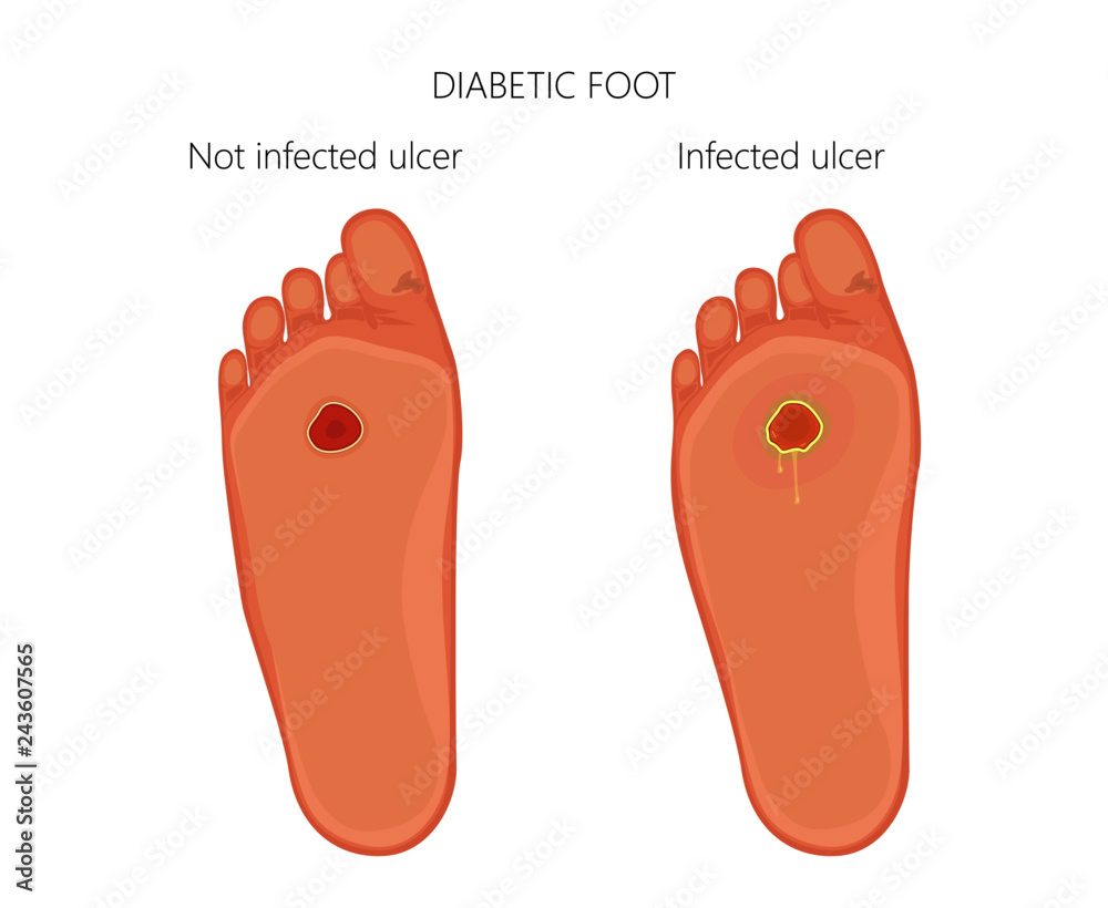 Vector illustration. Diabetic foot with not infected ulcer and diabetic