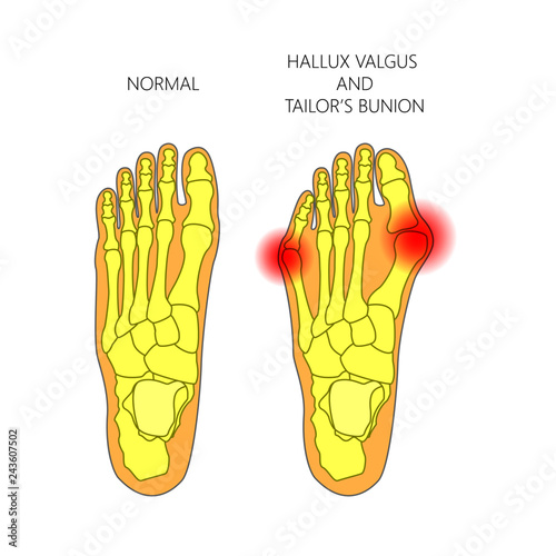 Illustration of the normal foot, valgus deviation of the first toe  and tailor's bunion.