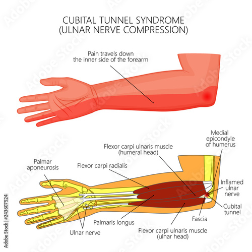 Illustration of Cubital tunnel syndrome or ulnar nerve impingement. photo