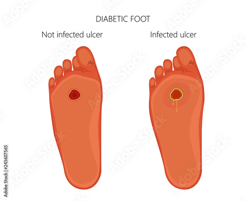 Vector illustration. Diabetic foot with not infected ulcer and diabetic foot with infected ulcer. Bottom view, sole.