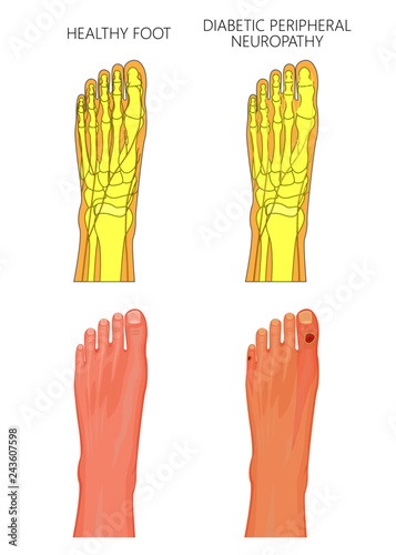 Illustration of Diabetic Peripheral Neuropathy. Healthy foot and foot with damaged nerves and ulcers on the toes