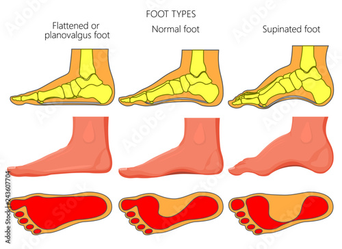 Vector illustration of the foot types. External and skeletal views of medial side of an ankle with footprint.