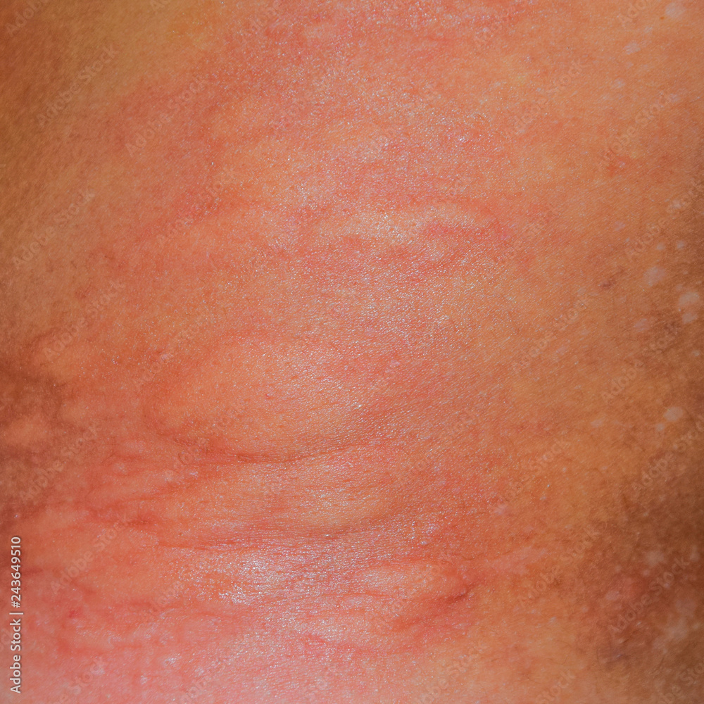 Allergy skin back and sides. Allergic reactions on the skin in t