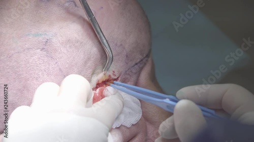 Hands of surgeon cauterize the incision with surgical coagulator and cuts the tissues of a wound close-up (4K, 25fps) photo