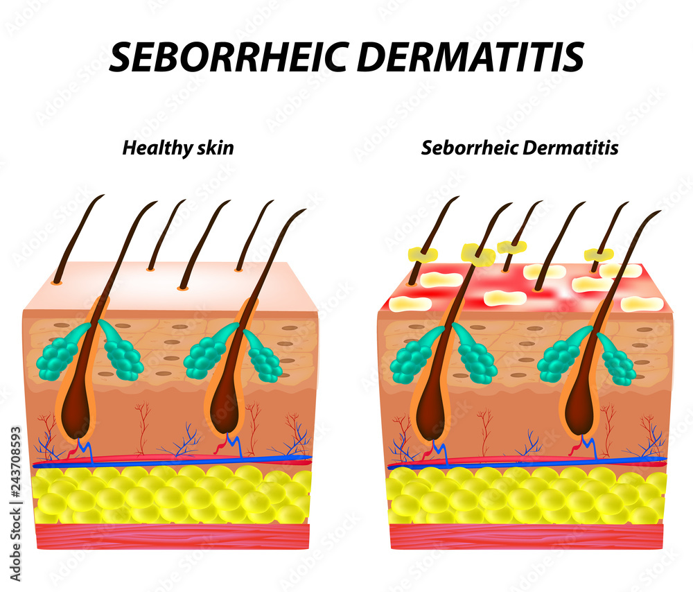 Seborrhea skin and hair. Dandruff seborrheic dermatitis. Eczema. Dysfunction of the sebaceous