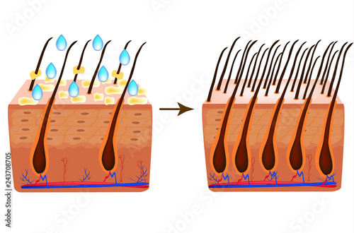 Treatment of alopecia. Vitamins hair. Biotin. Seborrhea skin and hair. Dandruff, seborrheic dermatitis. Baldness, hair growth, baldness. Anatomical structure. Infographics. Vector illustration.