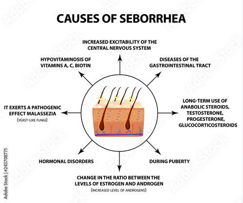 Causes of seborrhea. Seborrhea skin and hair. Dandruff, seborrheic dermatitis. Baldness, hair growth, baldness. Anatomical structure. Infographics. Vector illustration on isolated background.