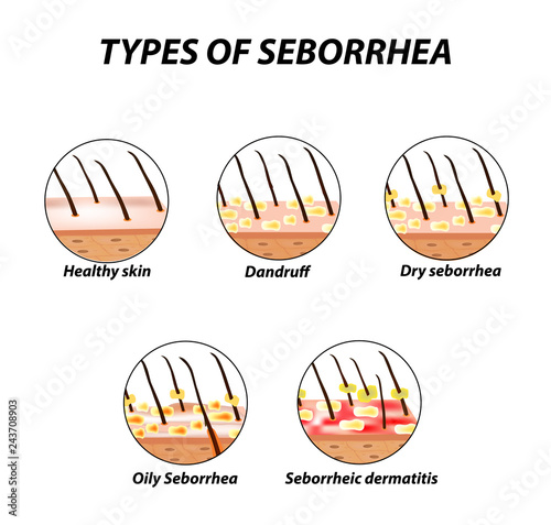 Types of seborrhea. Seborrhea skin and hair. Dandruff, seborrheic dermatitis. Baldness, hair growth, baldness. Anatomical structure. Infographics. Vector illustration on isolated background.