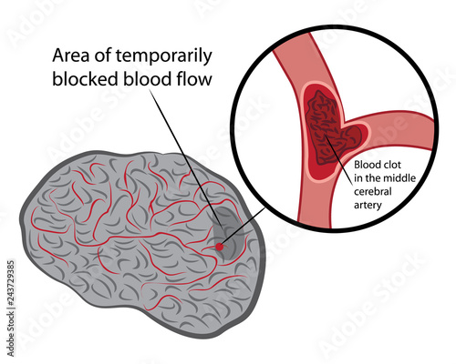 Stroke develope in human brains