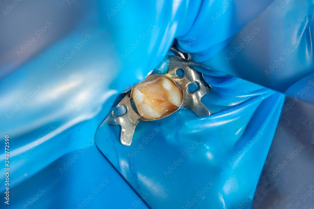 two chewing side teeth of the upper jaw after treatment of caries ...