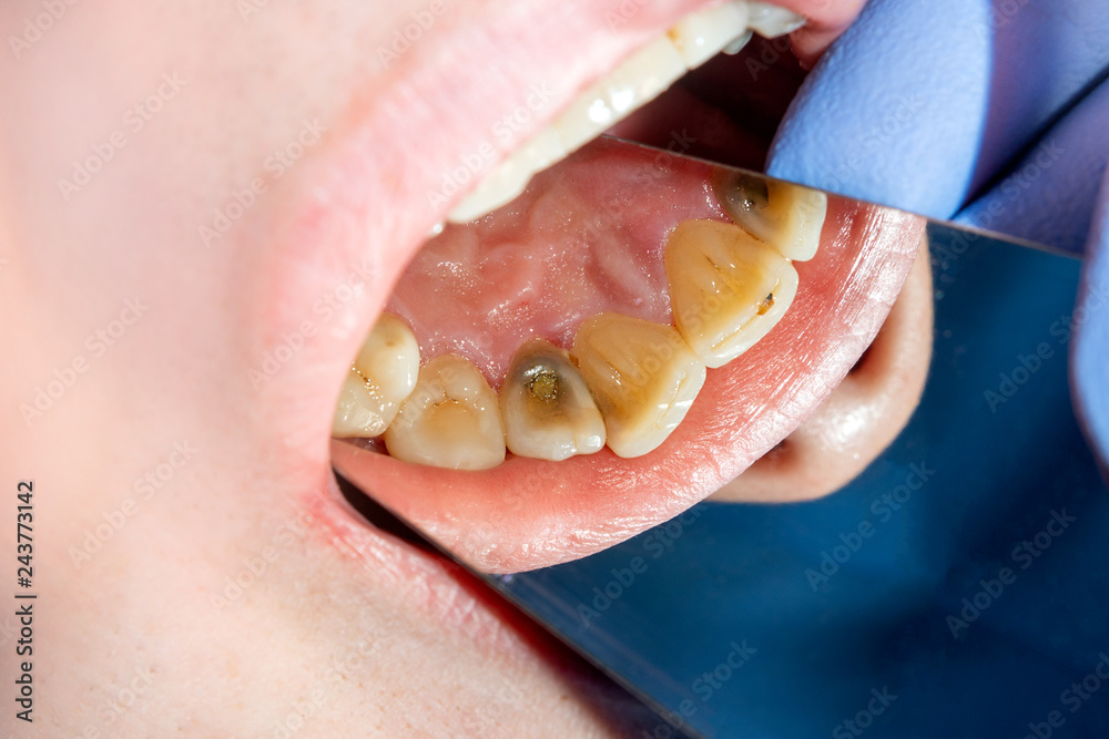 two chewing side teeth of the upper jaw after treatment of caries