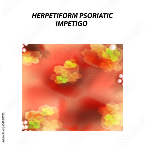 Herpetiform psoriatic impetigo. Eczema, dermatitis skin disease psoriasis. Infographics. Vector illustration on isolated background.
