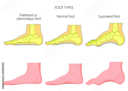 Foot types. External and skeletal views. photo