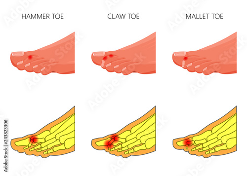 Illustration of the deformation of toes