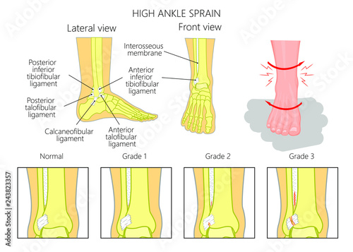 Illustration of Mechanism of formation of a High ankle sprain  (Syndesmotic Sprain) and Grades of high ankle sprain with external and skeletal (lateral and front) view of an ankle.
