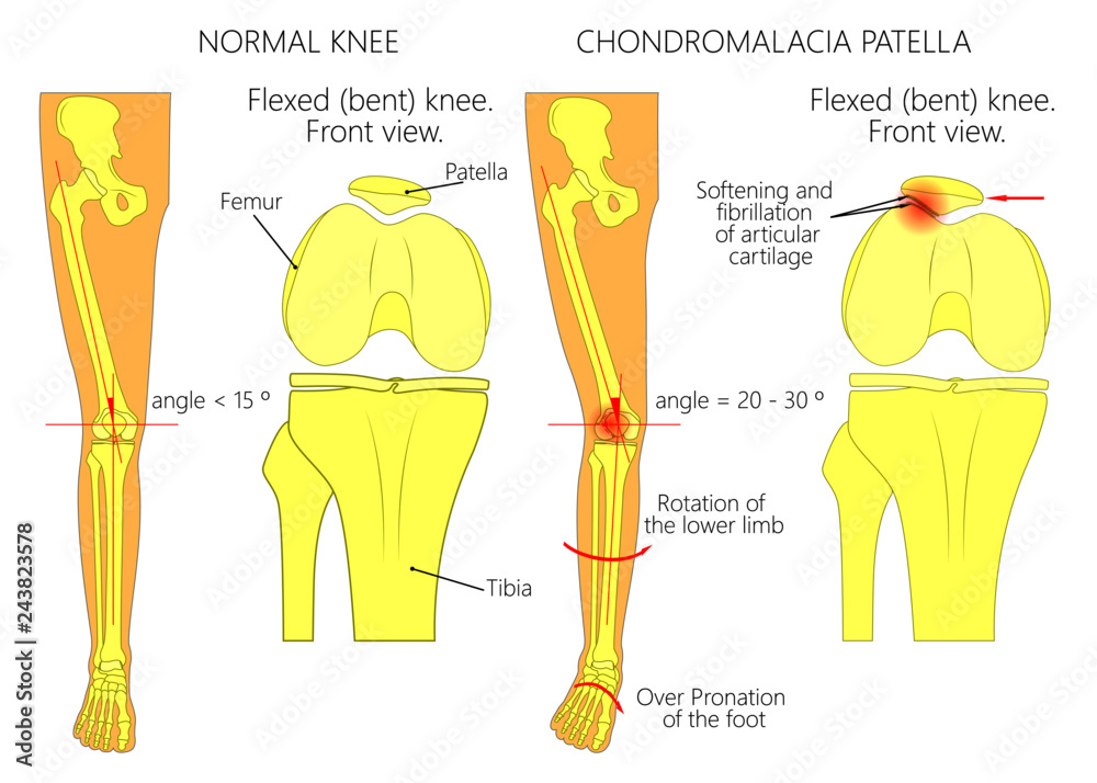 Illustration (diagram) of normal leg with a healthy knee and a leg with  over pronation of the foot arch and chondromalacia patella Stock Vector |  Adobe Stock