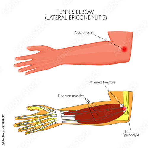 Illustration of Lateral Epicondylitis or tennis elbow.