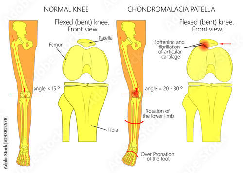 Illustration (diagram) of normal leg with a healthy knee and a leg with over pronation of the foot arch and chondromalacia patella photo
