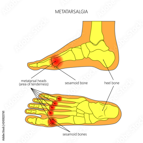 Vector diagram of forefoot pain, metatarsalgia symptom, tenderness in the balls of metatarsal bones of the foot. photo