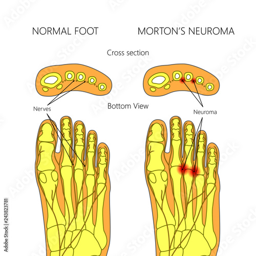 Morton's neuroma with cross section.