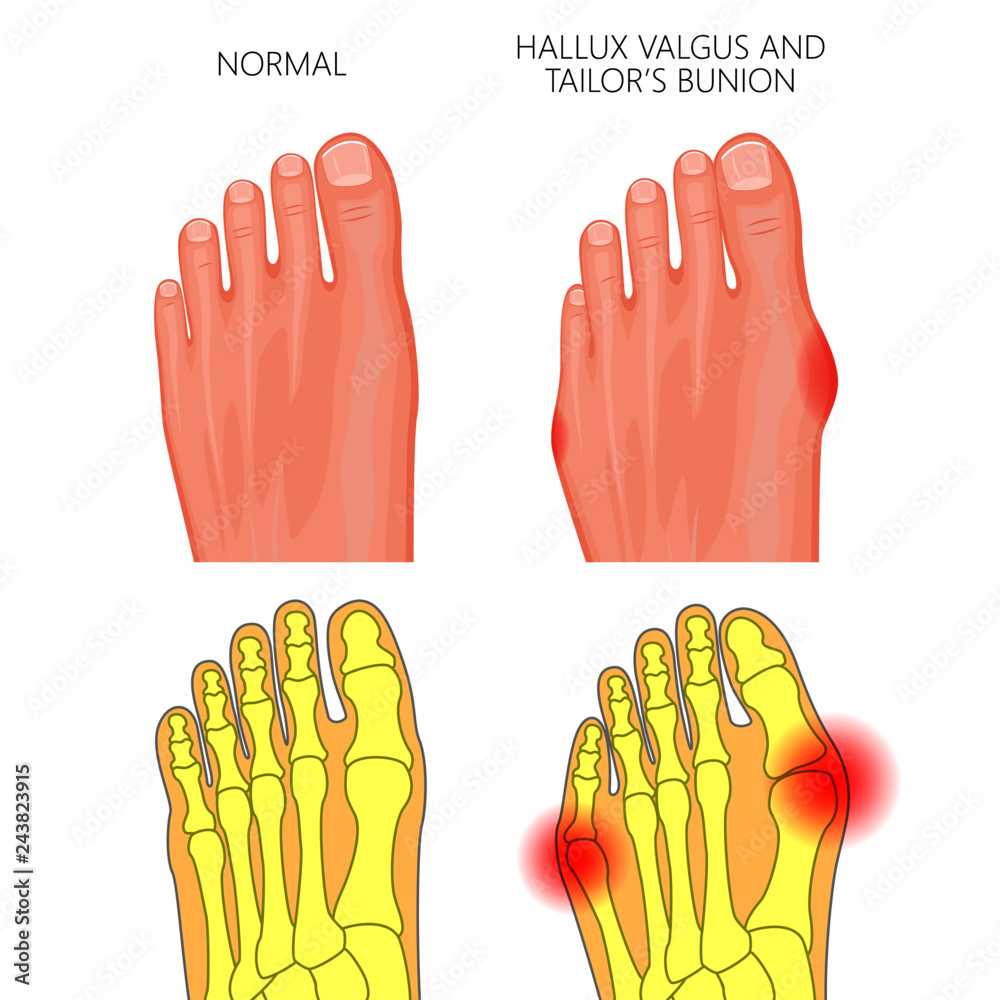 Illustration of the normal foot, valgus deviation of the first toe and