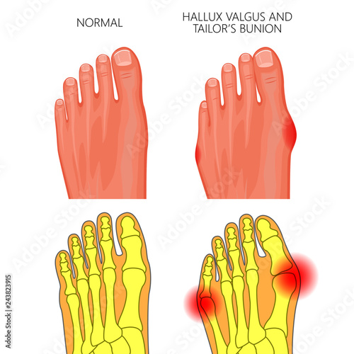 Illustration of the normal foot, valgus deviation of the first toe  and tailor's bunion. External and skeletal views.