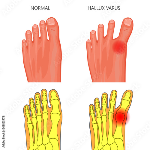 Illustration of the normal foot and hallux varus