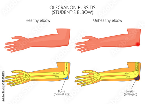 Illustration of Olecranon bursitis or student's elbow.  For medical publications