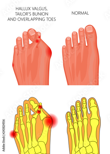 Illustration of the hallux valgus, Tailor's bunion and overlapping or displaced toes