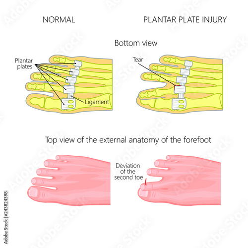 Vector illustration (diagram). Deviation of the toe. Mechanism of rupture of plantar plate of the seond toe of the foot. External and skeletal views of an ankle.