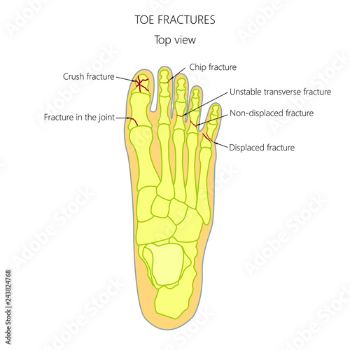 Illustration (diagram) of toe fracture types.