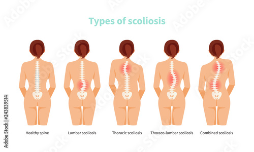 Types of scoliosis vector photo