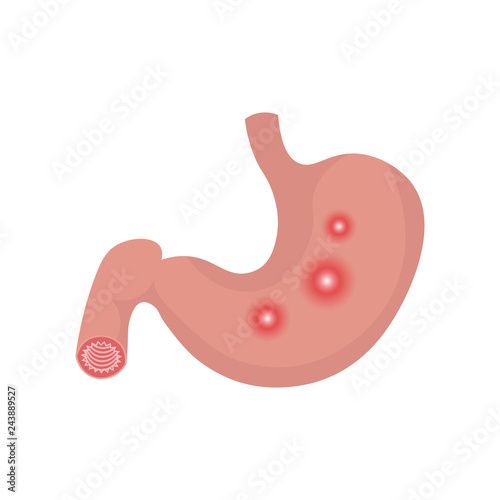 Illustration from acid reflux or heartburn