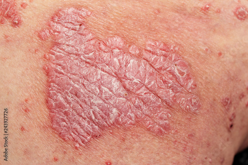 Detail of psoriatic skin disease Psoriasis Vulgaris with narrow focus, skin patches are typically red, itchy, and scaly photo